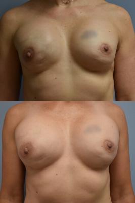 BREAST RECONSTRUCTION REVISION