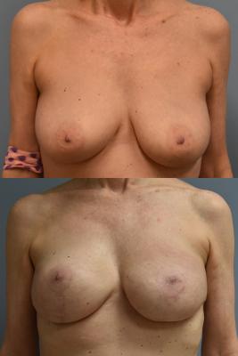 BREAST RECONSTRUCTION WITH TISSUE EXPANDERS AND ADM GRAFT