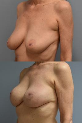 BREAST RECONSTRUCTION WITH TISSUE EXPANDERS AND ADM GRAFT