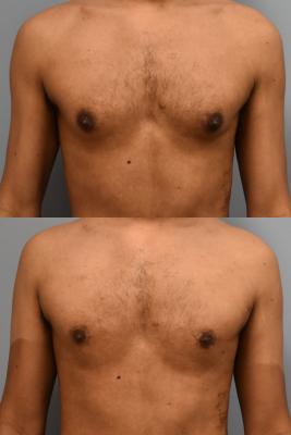 GYNECOMASTIA