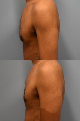 GYNECOMASTIA