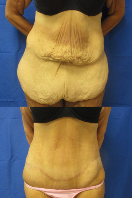 Panniculectomy before & after