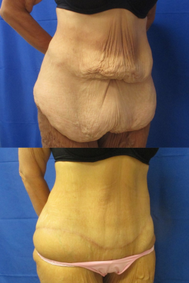 Panniculectomy before & after