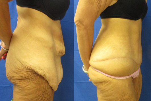 Panniculectomy before & after