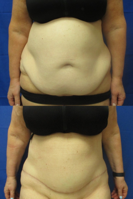 Panniculectomy before & after