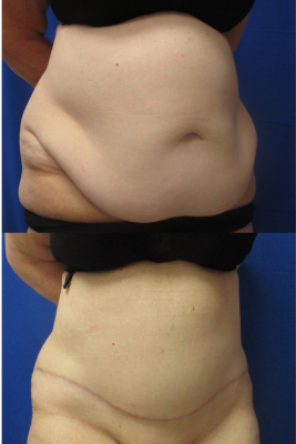 Panniculectomy before & after