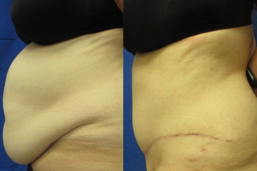Panniculectomy before & after