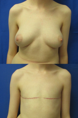 Gender affirming top surgery before & after