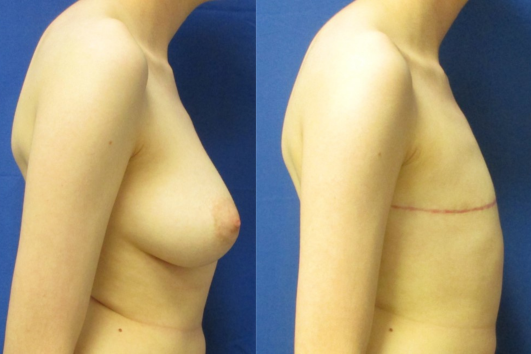 Gender affirming top surgery before & after