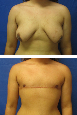 Gender affirming top surgery before & after