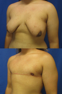 Gender affirming top surgery before & after