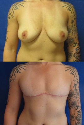 Gender affirming top surgery before & after