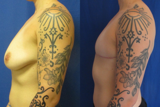 Gender affirming top surgery before & after