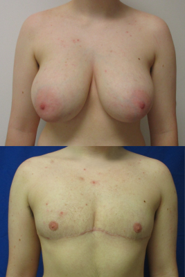 Gender affirming top surgery before & after