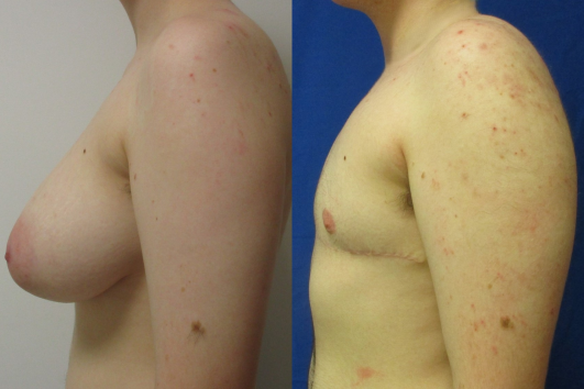 Gender affirming top surgery before & after
