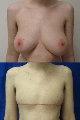 Gender affirming top surgery before & after
