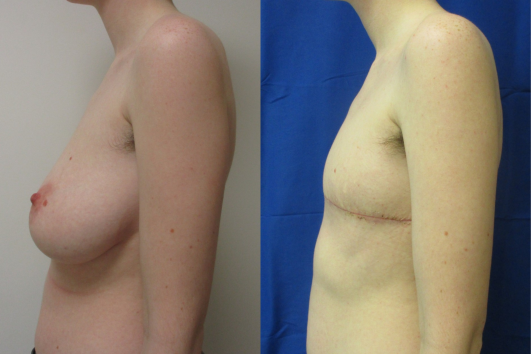 Gender affirming top surgery before & after