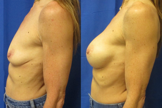Breast augmentation before & after