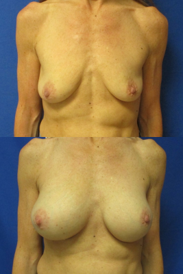 Breast augmentation before & after
