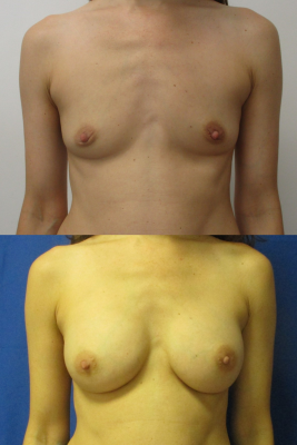 Breast augmentation before & after