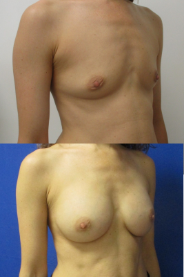 Breast augmentation before & after