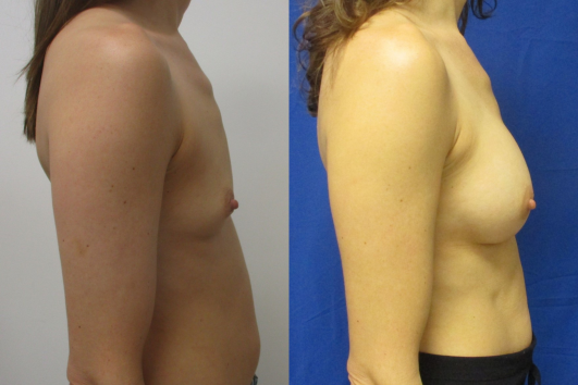 Breast augmentation before & after