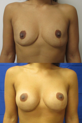 Breast augmentation before & after