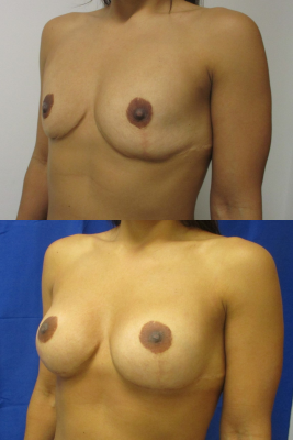 Breast augmentation before & after