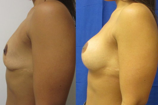 Breast augmentation before & after