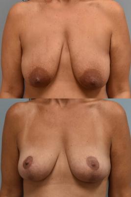 ONCOPLASTIC BREAST REDUCTION