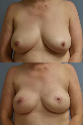 BREAST RECONSTRUCTION WITH TISSUE EXPANDERS