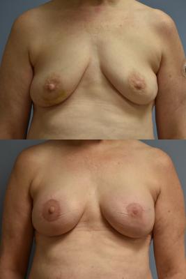 BREAST RECONSTRUCTION WITH TISSUE EXPANDERS