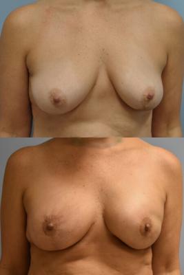 BREAST RECONSTRUCTION