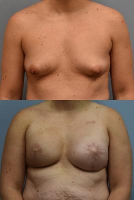 BREAST RECONSTRUCTION