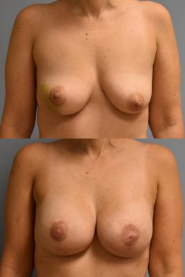 BREAST RECONSTRUCTION