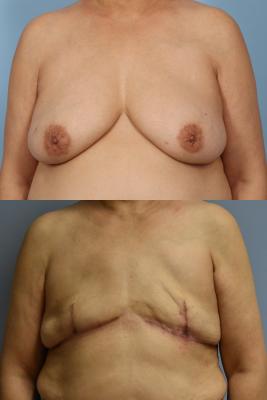 BREAST RECONSTRUCTION