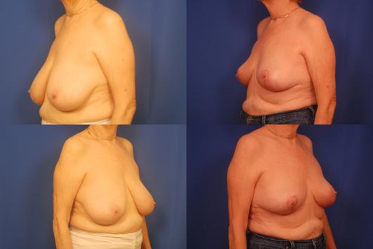 Bilateral-Breast-Reduction-G1_M1WAGGh.jpg