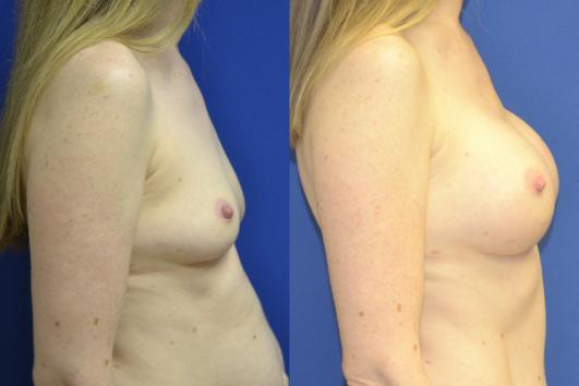 Mommy_makeover_5_3_breast_70FcUmk.jpg