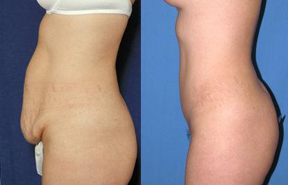 Pyo_Body_Contouring4515-65747FINAL.jpg