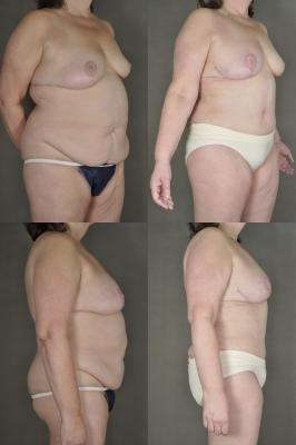 abdominoplasty-with-liposuction-g2.jpg