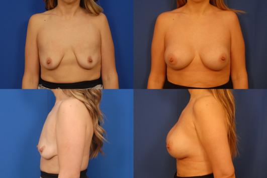 bilateral-breast-augmentation-with-silicone-G1_0X6yMBn.jpg