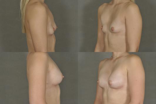 breast-asymmetry-augmentation-and-revision-p1_vsmvfmt.jpg