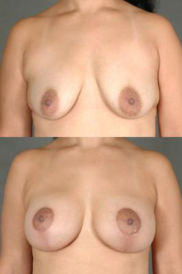 breast-augmentation-and-lift-p7.jpg