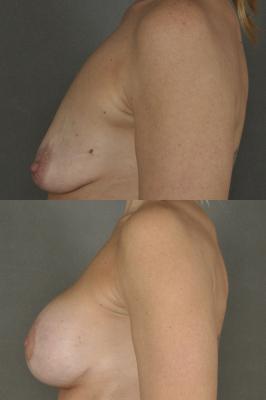 breast-augmentation-and-lift-p8_1A113Nh.jpg