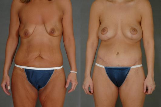 breast-augmentation-and-tummy-tuck-p1.jpg