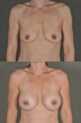breast-augmentation-p13.jpg