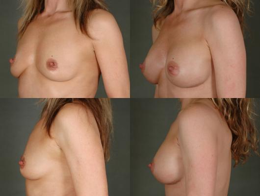 breast-augmentation-p14_TPEkJlL.jpg