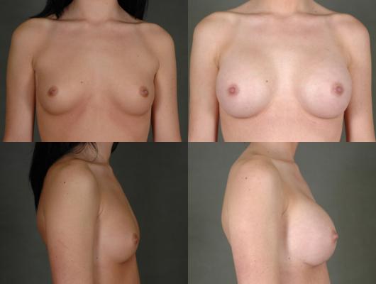 breast-augmentation-p15.jpg