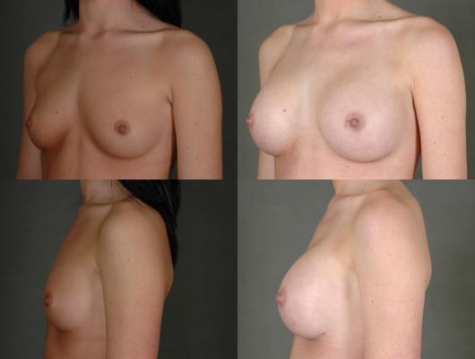 breast-augmentation-p15_dJhL0GA.jpg