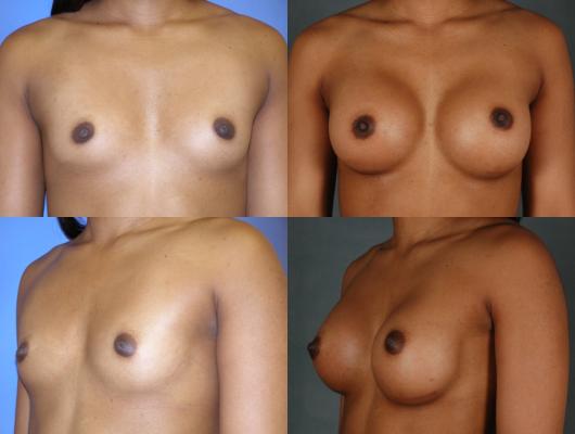 breast-augmentation-p18_rsVWsgh.jpg